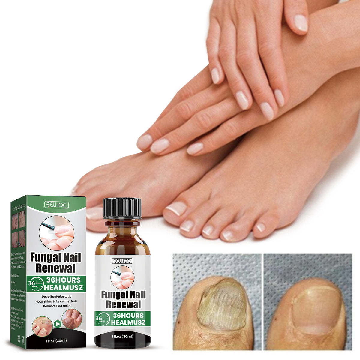 EELHOE Gray Nail Repair Remove Gray Nail Nourishing Lotion, Brightening Soft Nails Moisturizing Nail Care Solution For Hands, Feet And Nails