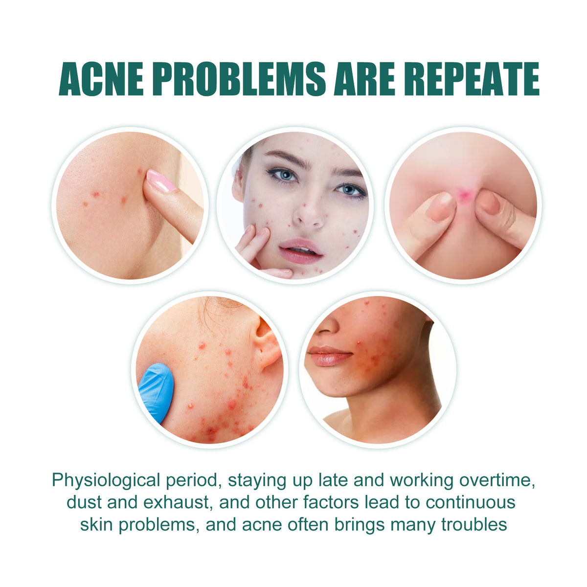EELHOE Star Acne Patch Gentle Cleansing Lighten Acne Soothing Skin Acne Patch Facial Cleansing Treatment